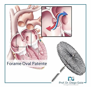 Respect Trial demonstra segurança e eficácia do fechamento do FOP (forame oval patente)