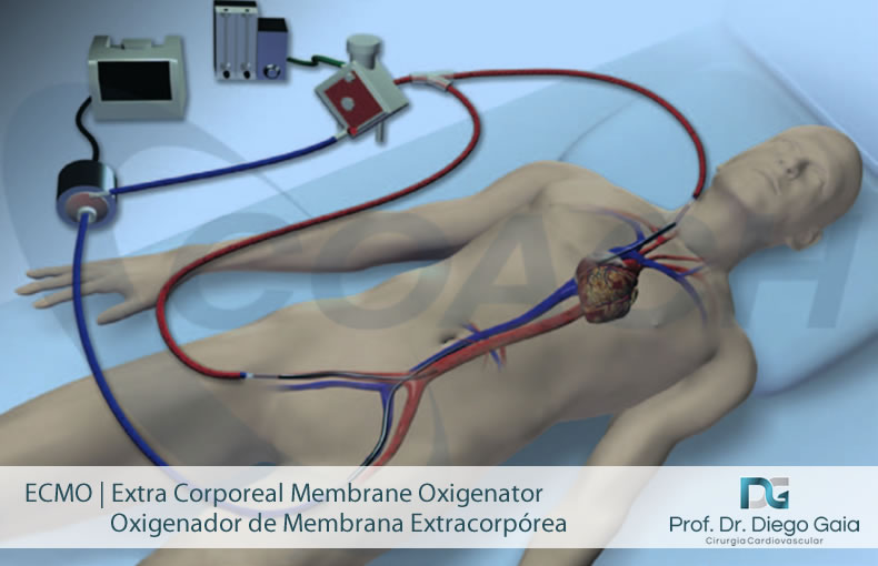 ecmo.jpg