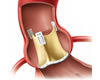 Estenose e Insuficiência AórticaCirúrgico