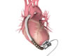 Insuficiência Cardíaca - Tratamento Cirúrgicoe Coração Artificial