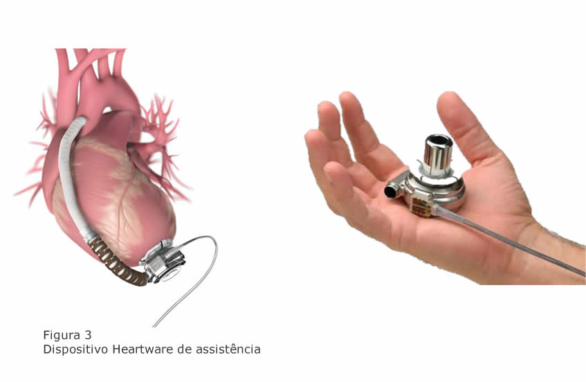 dispositivo-heartware-assistencia