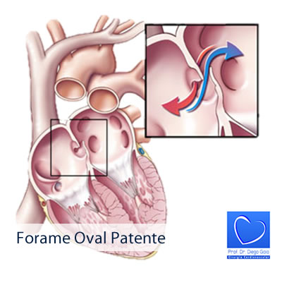 Forame Oval Patente