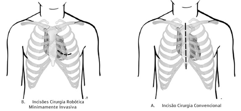 revascularizacao-do-miocardio3