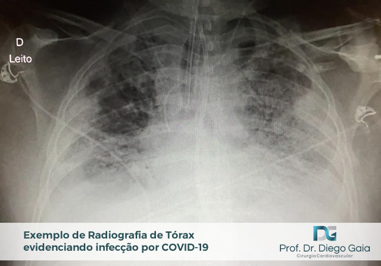 radiografia-infeccao-h1n1.jpg