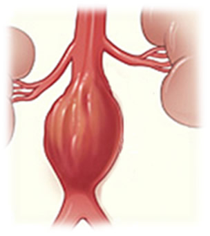 Aneurisma da Aorta Abdominal