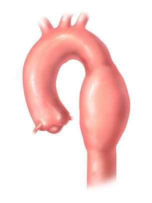 Aneurisma da Aorta Torácica