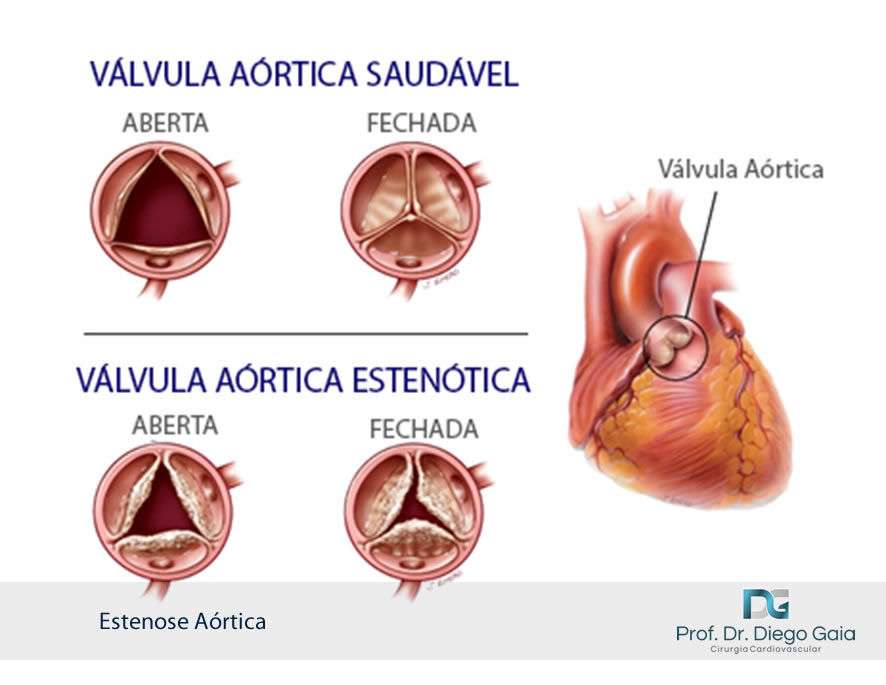 valvula-aortica-estenotica