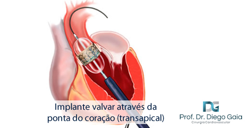 implante-valvar