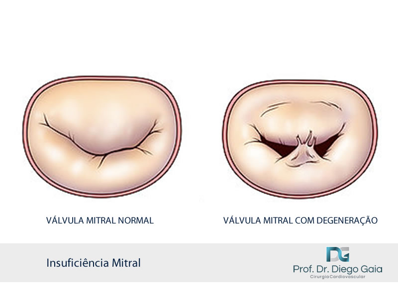 Insuficiência Mitral