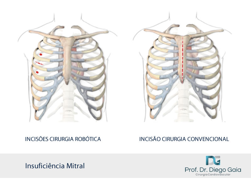 Insuficiência Mitral