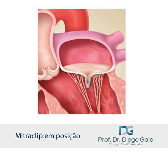 insuficiencia mitral mitralclip