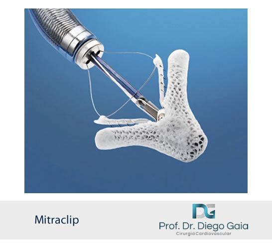 insuficiencia mitral mitralclip2