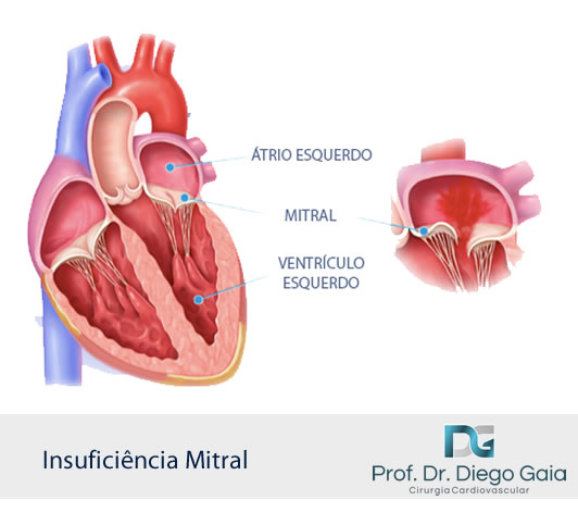 Insuficiencia Mitral