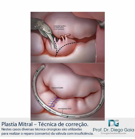 Plastia Mitral