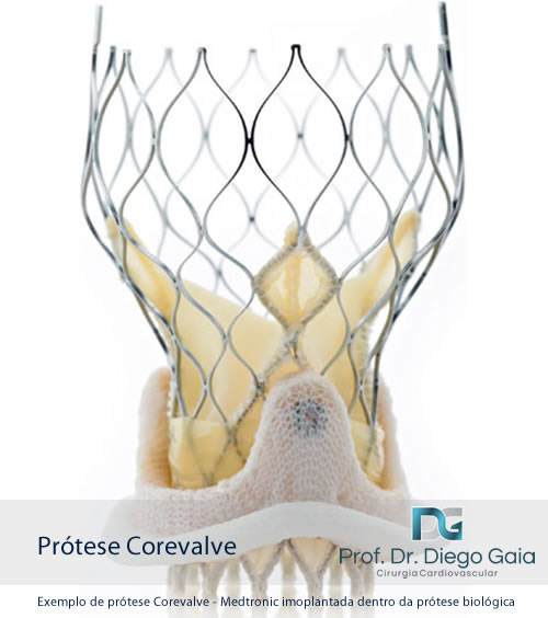 Prótese Corevalve