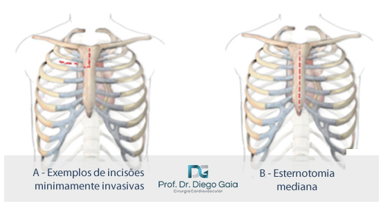 tratamento-cirurgico-minimamente-invasivo